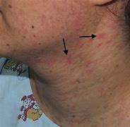 Image result for Epidermodysplasia Verruciformis Oral Lesions