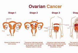 Image result for Bloating and Ovarian Cancer