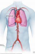 Image result for Blocked Coronary Artery Angiogram