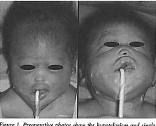 Image result for Holoprosencephaly