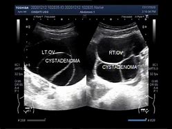 Image result for Cystadenomas Ovarian Cyst Ultrasound