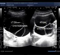 Image result for Ovarian Cystadenoma Ultrasound