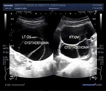 Image result for Cystadenomas Ovarian Cyst