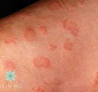 Image result for Fungal Skin Infections Photos