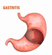 Image result for gastritis