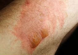 Image result for 2nd Degree Burn From Sun