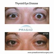 Image result for Autoimmune Thyroid Eye Disease