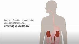 Image result for Urostomy Myelomeningocele