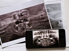 Image result for Embedded Teeth