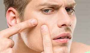 Image result for Giant Pimple Popping