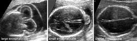 Image result for Anencephaly Mickey Mouse