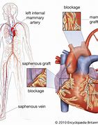 Image result for Vascular Bypass