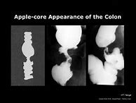 Image result for Radiopaedia Apple Core Sign