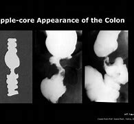 Image result for Apple Core Colon Cancer