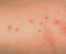 Image result for Bed Bug Bites On Stomach