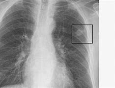 Image result for 7 mm Lung Nodule