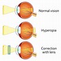 Image result for Curvature Myopia