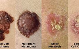 Image result for Cancerous Lesions On Skin