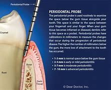 Image result for Periodontitis Pockets
