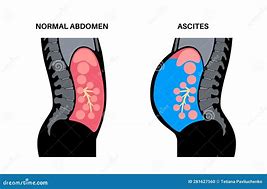 Image result for Distended Abdomen vs Ascites