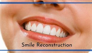 Image result for Reconstructed Smiles