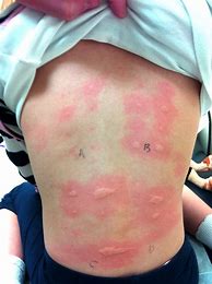 Image result for Copper Allergy Rash