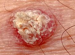 Image result for Gingival Squamous Cell Carcinoma
