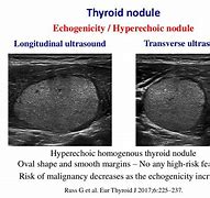 Image result for Hypoechoic Thyroid Nodule Ultrasound