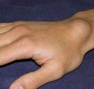 Image result for Accessory Bones Wrist