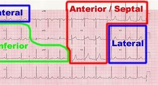Image result for Leads for Anterior MI