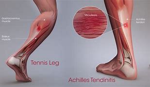 Image result for Calf Muscle Achilles Tendon Pain