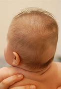 Image result for Plagiocephaly