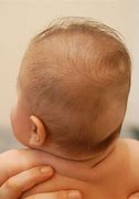 Image result for Posterior Plagiocephaly