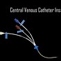 Image result for Central Venous Pressure CVP