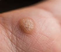 Image result for Warts On Skin