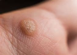 Image result for Flat Warts Verruca Plana