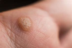 Image result for Water Warts in Adults