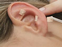 Image result for acupuntura