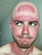 Image result for Sun Burn On Bald Head