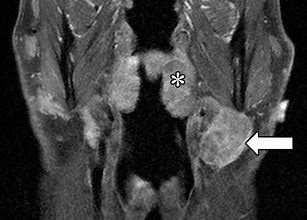 Image result for N Staging of Head and Neck Cancers