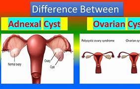 Image result for Management of Adnexal Cyst