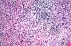 Image result for Inflammatory Polyp Colon Histology
