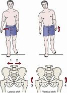 Image result for Lateral Shift of Pelvis