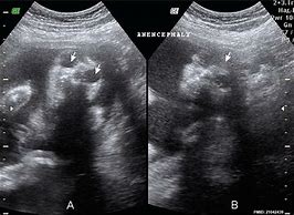 Image result for Anencephaly On Ultrasound