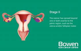 Image result for Ovarian Cancer Removed