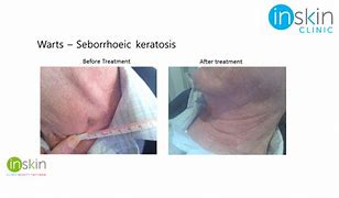 Image result for Seborrhoeic Warts Treatment