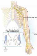 Image result for Wrist Pain Pinky Side