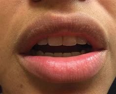 Image result for White Spots On Lips