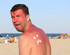 Image result for Back Beach Sun Burn