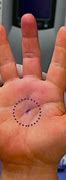 Image result for Trigger Finger Tendon Release